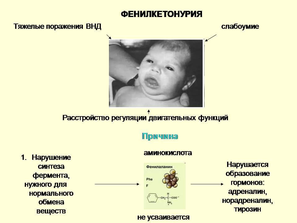 Фенилкетонурия презентация по генетике