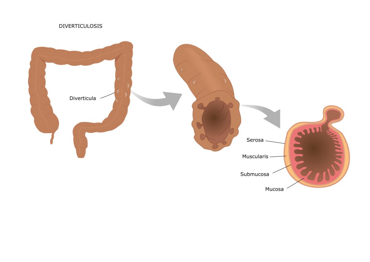 Дивертикул кишечника картинки