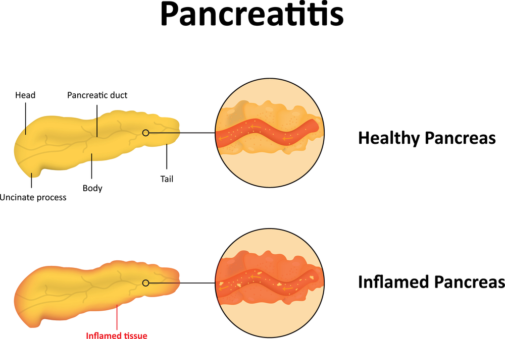 Панкреатит где находится у человека фото